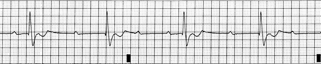3 RD DEGREE AV BLOCK (COMPLETE HEART BLOCK) Characteristics - No atrial impulses are transmitted to the ventricles - Atria and ventricles beat independently of each other - AV dissociation -