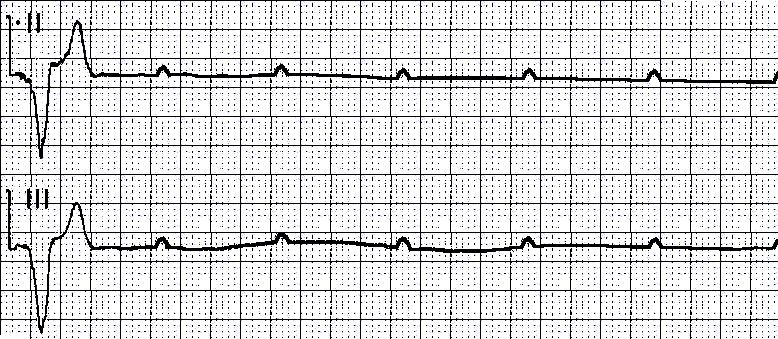 VENTRICULAR STANDSTILL Characteristics - Absence of electrical activity in the ventricles - When the escape pacemaker fails in heart block - There is normal atrial activity with no ventricular