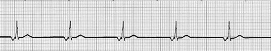 JUNCTIONAL RHYTHM Characteristics - Delayed heartbeat originating from an ectopic focus in the AV junction - Occurs when the rate of depolarisation of the SA node falls below the rate of the AV node