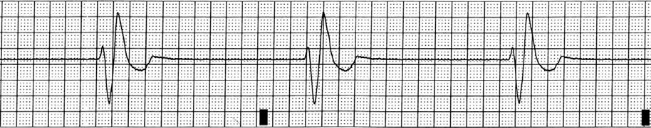 IDIOVENTRICULAR RHYTHM Characteristics - Arrhythmia originating in a secondary pacemaker site in the ventricle - Escape or rescue rhythm, protective mechanism, impulse initiated when higher pacemaker
