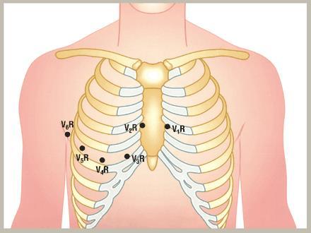 RIGHT SIDED V-LEAD PLACEMENT V1R: Left 4 th intercostal space V2R: Right 4 th intercostal space V3R: Halfway between V2 and V4 V4R: Right 5 th intercostal space, mid-clavicular line V5R: Horizontal