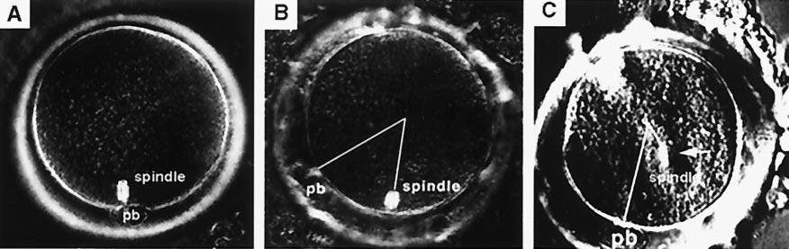FIGURE 1 Spindles in living human imaged by using the polscope just before ICSI. (A), An oocyte with a spindle located just under the plasma membrane, near the polar body.