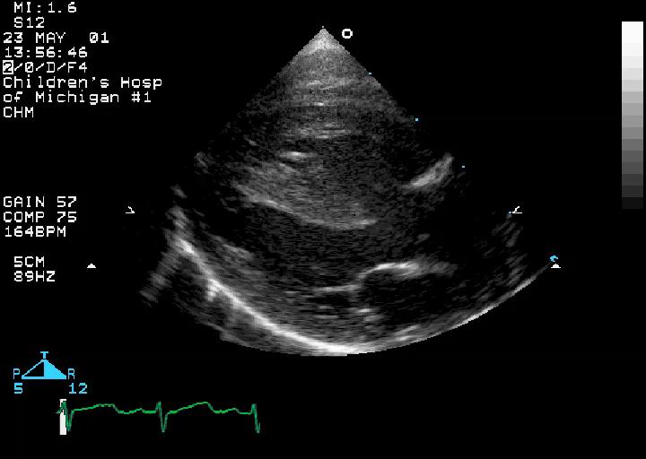 Case 5 Case 5 Question 1 What is the most common congenital heart defect presenting with this long axis view? 1. Transposition of the great arteries 2.