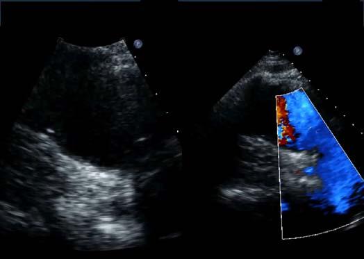 Case 1 Case 1 The echocardiographic finding shown is highly associated with which of the following genetic