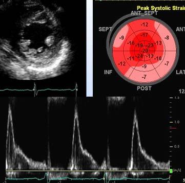Following 2-D, mitral inflow Doppler, and strain imaging were obtained from 72 year old man with