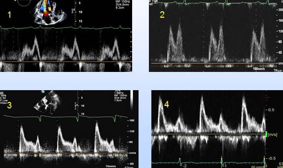 Case 3. Which of following mitral inflow patterns indicate the most optimal diastolic function status in 62 year old woman with ischemic CM? 1 2 3 4 Case 4.