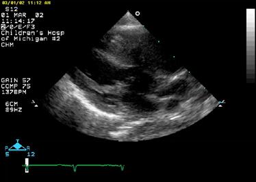 Case 1 The echocardiographic finding shown is highly