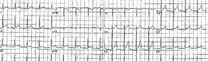 74 year old man with chest pain for