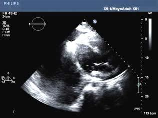 Q5 Following 2-D and MV Doppler echocardiograms were obtained from a