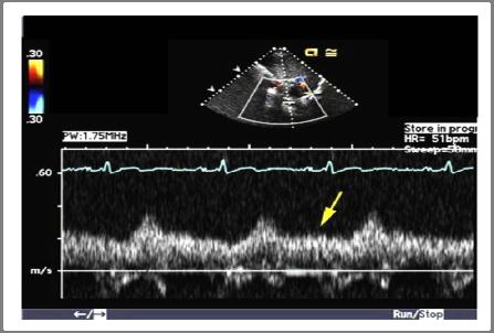 This aortic pulsed wave Doppler examination was performed in a patient