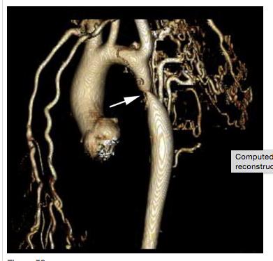 Coarctation of the Aorta Reduced and delayed systolic forward flow with
