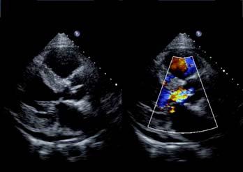 42 year old woman with shortness of breath with exertion What is the most likely diagnosis? 1.Bicuspid aortic valve 2. HOCM 3. Corrected transposition of the great vessels 4.