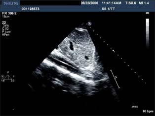 A 72 male patients presents with abdominal pain. A TTE is performed What is the most likely diagnosis? 1. Aortic thrombus 2.