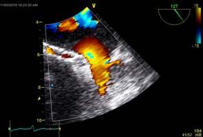 the structure Apply color Doppler as its respect for solid structures can be helpful Apply PW
