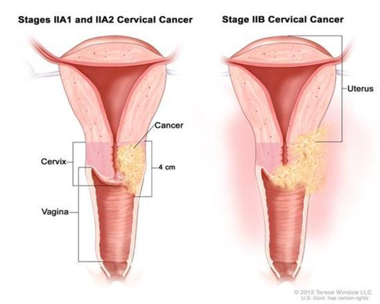 24 Treatment protocols for cervical cancer are provided below, including treatment by stage, chemo radiation therapy, and chemotherapy. Stage IA1 disease: Cancer cells are found only in the cervix.