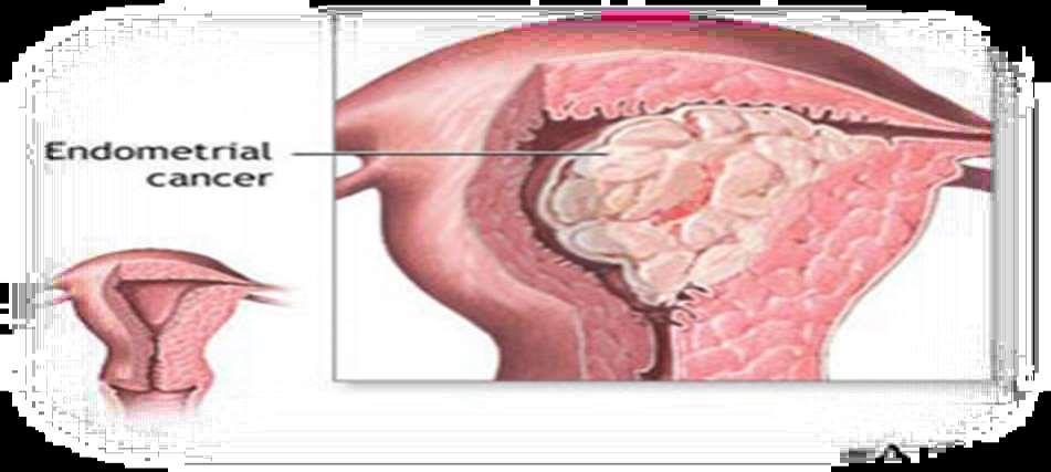 Endometrial Cancer Endometrial cancer also known as (uterine