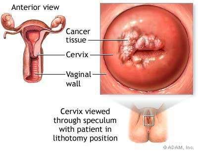 Cervical Cancer Cervical cancer
