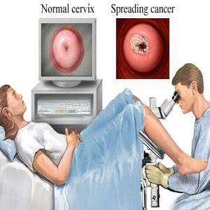Colposcopy Medical Test A procedure that allows doctor to