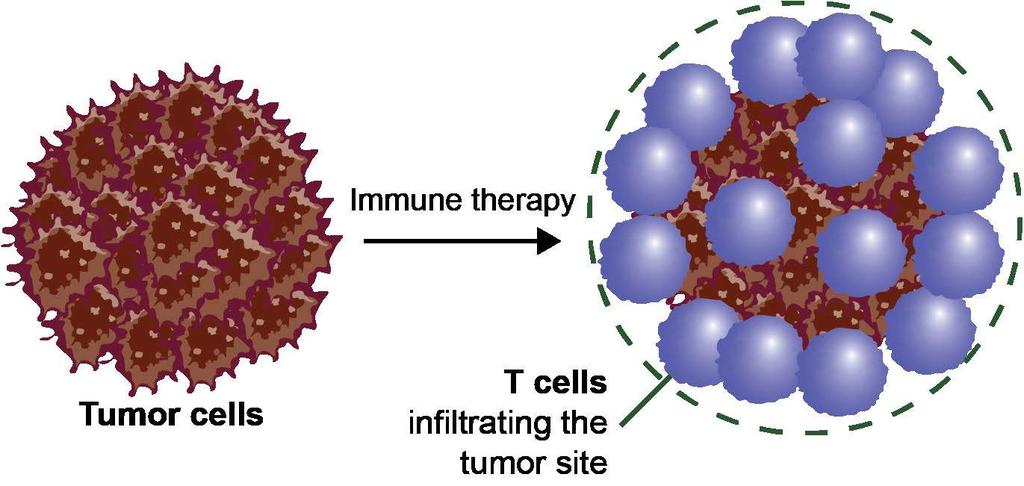 Tumor Flare With Immunotherapy 1 In patients on immunotherapy, tumor flare or