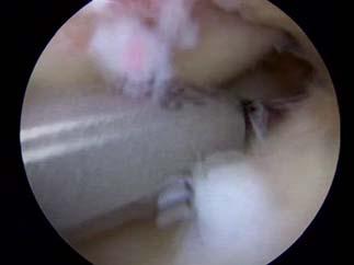 technique all inside meniscal root repair at the native root attachment site and eliminates the need for tunnel