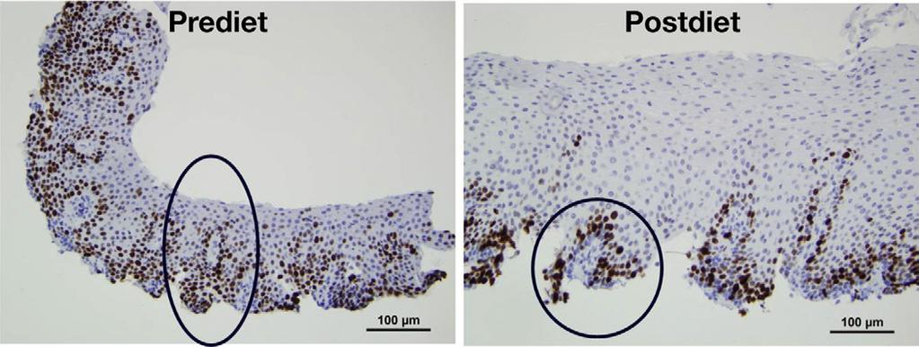 Right: reduction of ki-67 staining after SFED and staining only in the basal layer as expected. proximal and distal esophagus, respectively (P.0001).