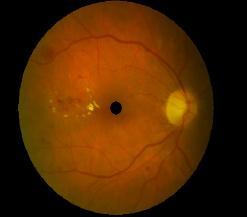One of the major problems faces exudates detection is the color similarity between optic disc and exudates. 2.
