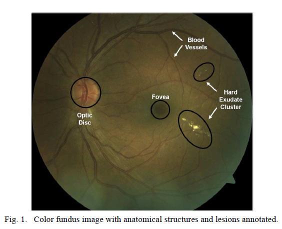 loss. In this paper, a two-stage methodology for the detection and classification of DME severity from color fundus images is proposed.
