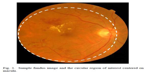 In order to develop a solution for automatic DME assessment, first a decision module is required to validate the presence or absence of HE in a given color fundus image.