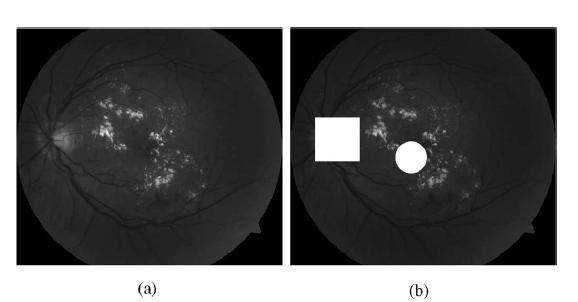 [1] Region of Interest Extractions: Since the severity of DME is determined based on the location of HE clusters relative to the macula, the images acquired for DME detection usually focus around the