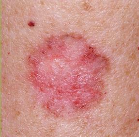 Account for about two-thirds of all skin cancers.
