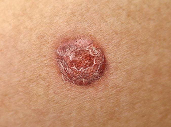 Squamous Cell carcinomas account for about one third of all skin cancers and grow