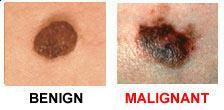 Melanoma accounts for less than 2% of all skin cancers but is the most dangerous and aggressive type of