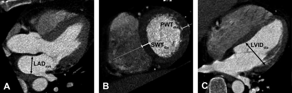 Investigative Radiology Volume 43, Number 5, May 2008 LV and LA Dimensions and Volumes years, range 41 88 years) who were referred for a clinically indicated CT coronary angiography examination were