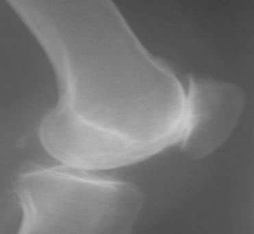 Isolated patellofemoral osteoarthtitis Isolated arthritis affects the patellofemoral is rare
