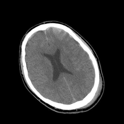 Our Patient AB: Subdural Hematoma and Subarachnoid