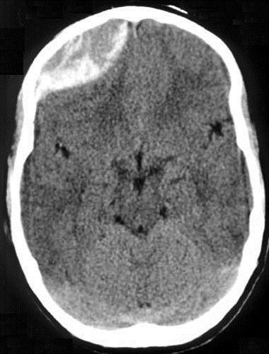 Companion Patient #1: Epidural Hematoma Blood in the potential space between the periosteum of inner table of the skull and the dura mater Arterial bleeding in 85% of cases Most often at the coup
