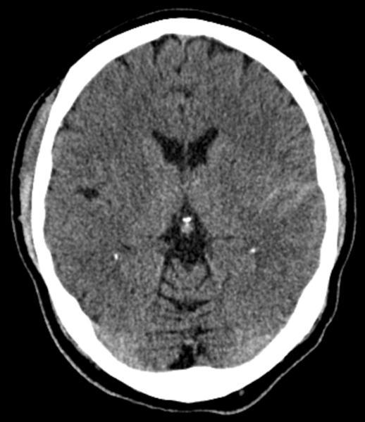 Companion Patient #3: Subarachnoid Hemorrhage Blood in the subarachnoid space (between arachnoid and pia mater) Bleeding from small pial or arachnoidal cortical vessels or extension of intracerebral