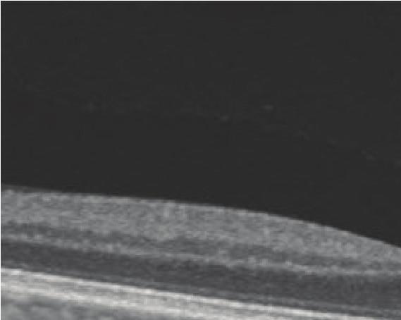 2 Case Reports in Ophthalmological Medicine (a) (b) Figure 1: (a) Central horizontal 6 mm scan: the PVC seems to be completely detached (total PVD) (white arrows).