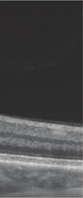 One horizontal 12 mm scan was conducted including the optic nerve head (ONH) as well as the fovea centralis. By default, an A-scan rate of 100000 Hz was used.