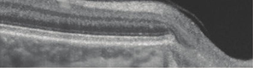PVD, while the completely detached PVC remains closely anterior to the retina within the scanning frame (Figure 2(b)), which in turn is oftentimes not the case.