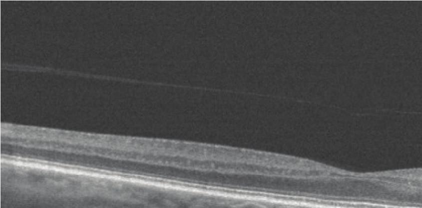 Future developments in respect to both variables will potentially help to distinguish between the PVC and the ILM of the neurosensory retina even if the PVC is still completely attached.