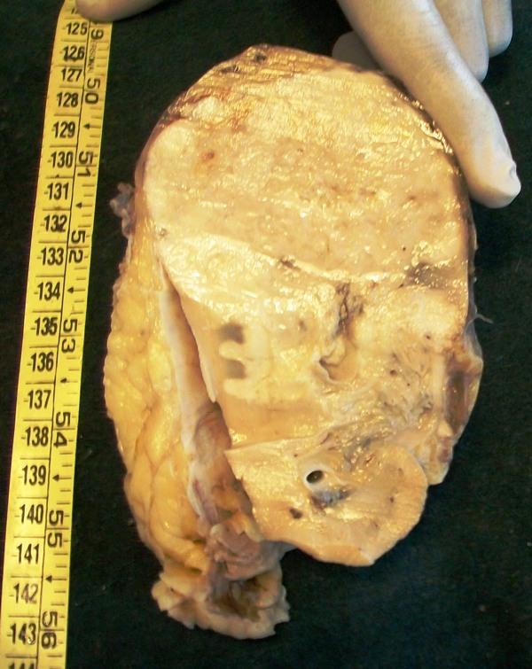 Gross: Irregular renal mass with perinephric fat, without ureter and any vessel. Cut section showed poorly circumscribed tumor mass measuring around 8x8 cms and areas of necrosis.