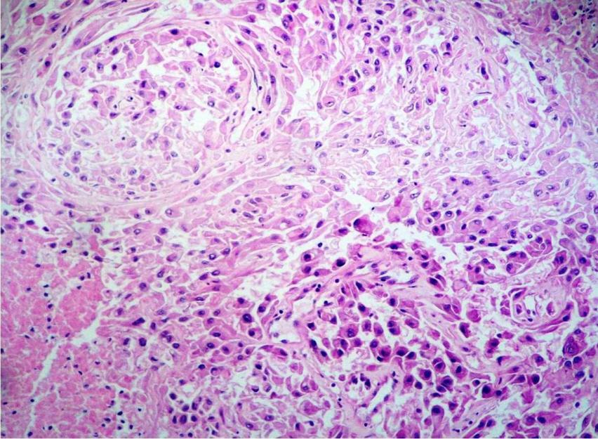 (H&E; 4x) Figure:3 Tumor cells with epithelial pearl
