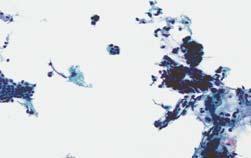clusters HSIL: Cytologic Features Cells occur singly, in sheets and in syncytial like aggregates.
