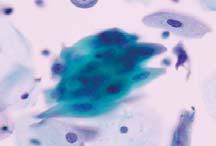 smears Maturing Squamous Metaplasia Lower N/C ratio, with finely