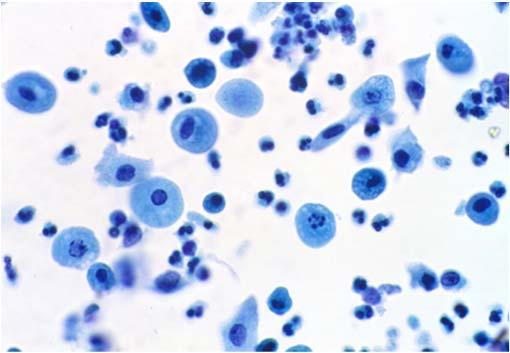 Maturation Index Atrophy: Parabasal Cells : :