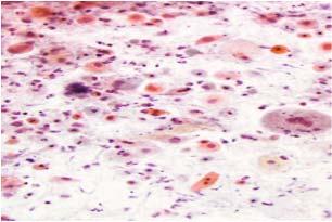 Atrophy: Degenerated parabasal cells Blue blobs Atrophy: Stripped nuclei (Should elicit search for classic intact HSIL).