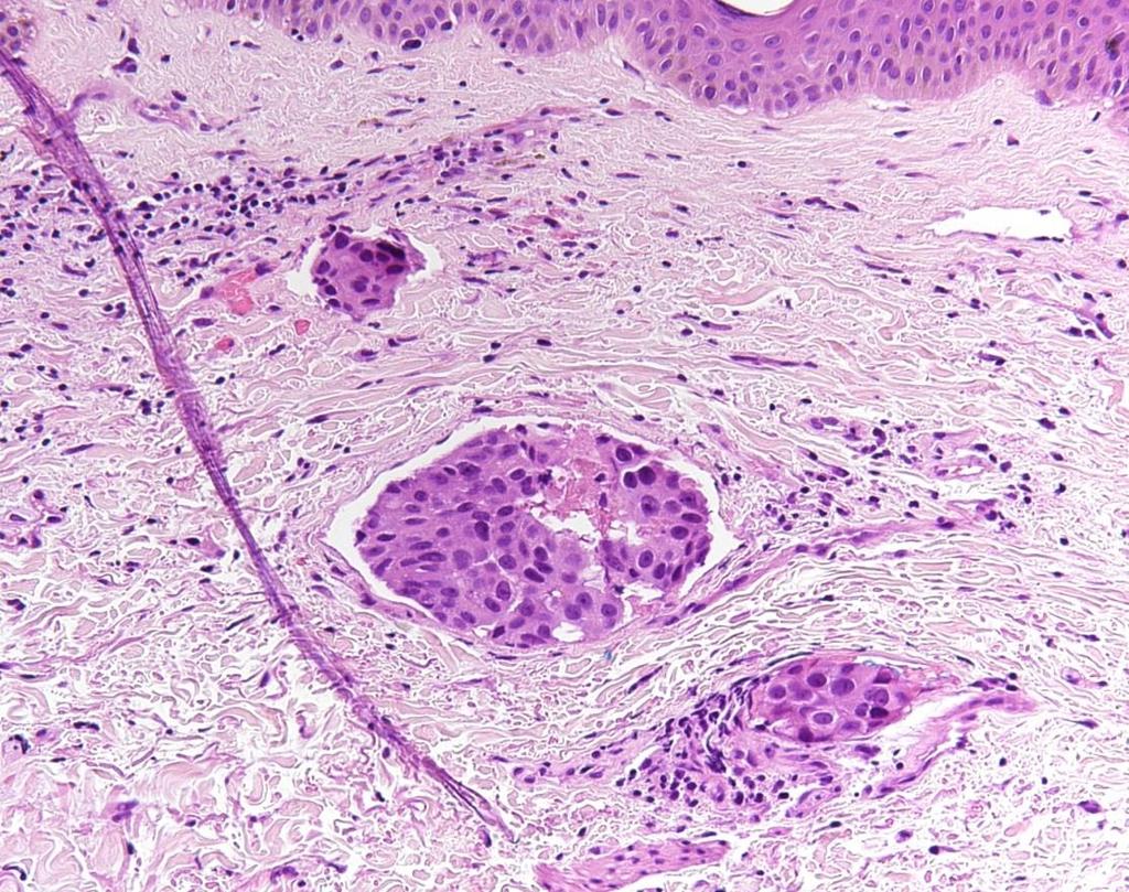 Breast (Mammary) Neoplastic cells filling