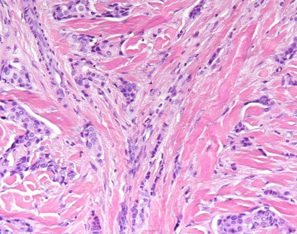 Breast (Mammary) Small nests and strands of neoplastic cells