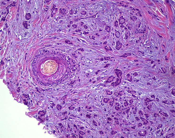 Breast (Mammary) Scalp hair follicles overrun by nests